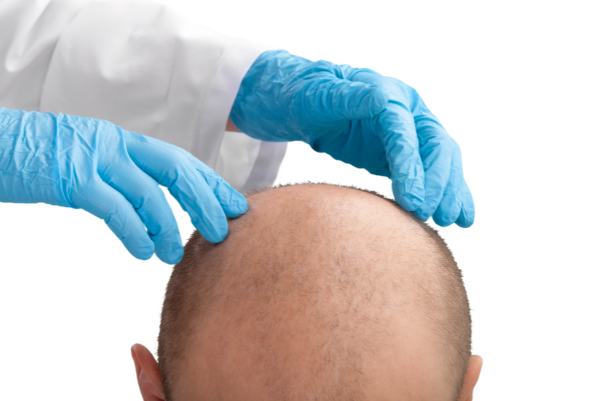 Hair Specialist in Indore  Hair Loss Doctors in Indore
